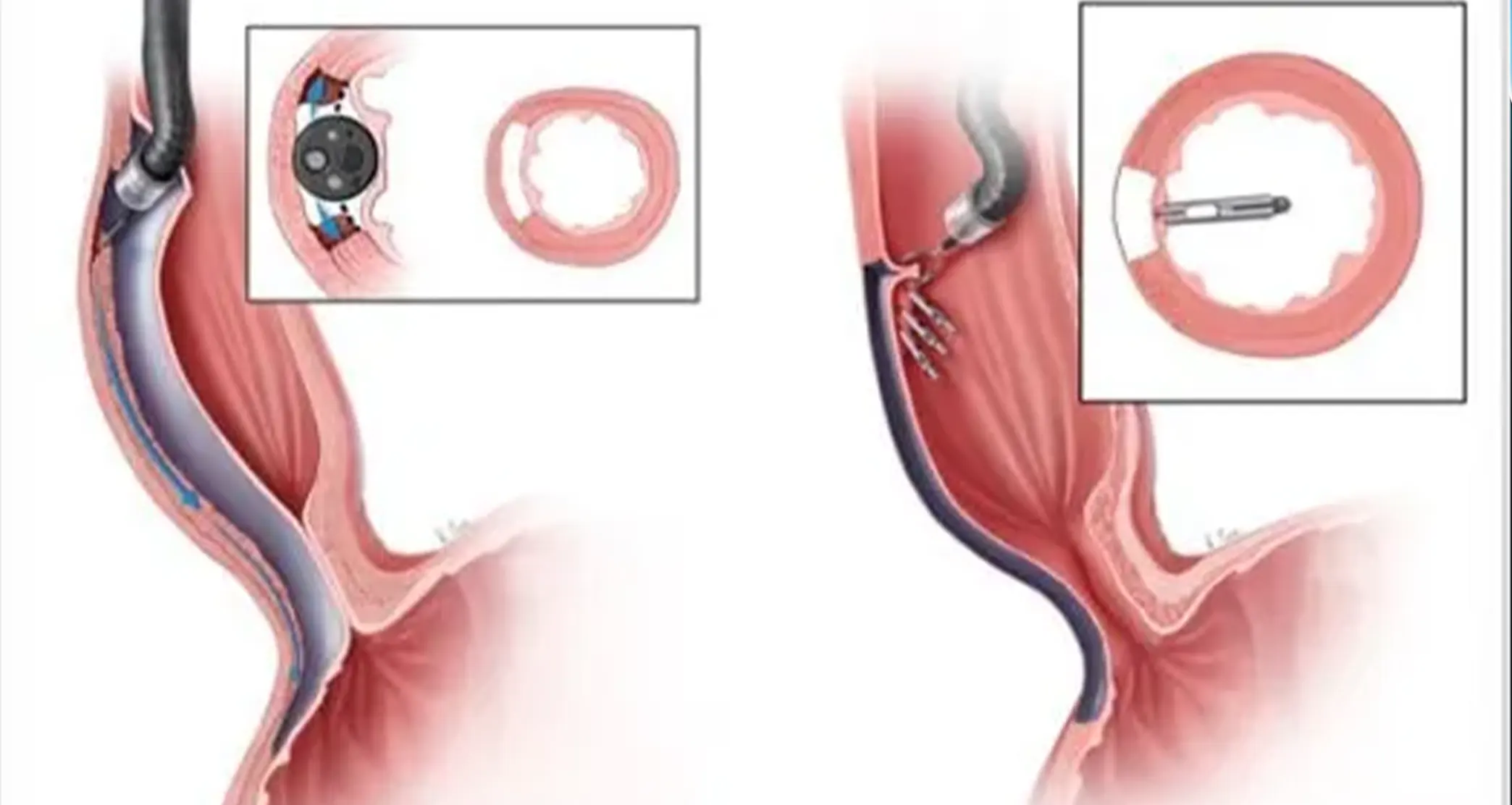 Endoscopic Treatment of Strictures & Polyps